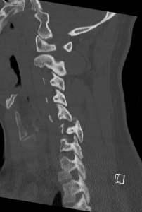 Dislocated Cervical Spine Dr John Albietz 3