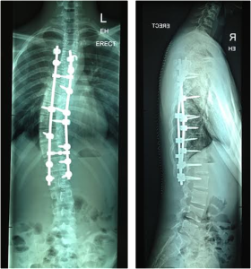 scoliosis after