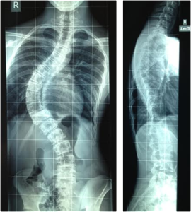 scoliosis before