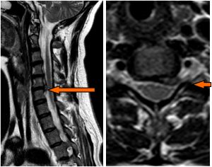 Cervial disc replacement before