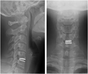 cervical disc replacement after